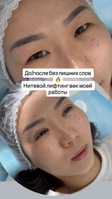 Брови: Нитевая блефаропластика «Сингапури» без операции ✨ Процедура — 13