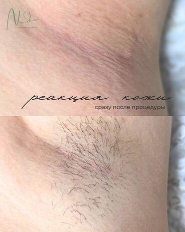 курсы депиляции: Электроэпиляция НЕДОРОГО instagram: nuda.kg Для всех зон. Для любых