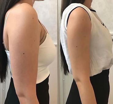 Красота и здоровье: Lipo Lab V-Line Solution — инъекционный липолитик для коррекции — 8