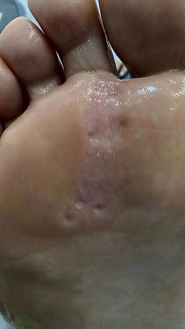 Маникюр: Коррекция вросших ногтей, Услуги подолога, Консультация — 5