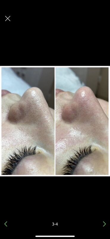 Косметология: Косметология, Ботокс, Биоревитализация, Ботулинотерапия, Консультация, Гипоаллергенные материалы, Сертифицированный косметолог — 50