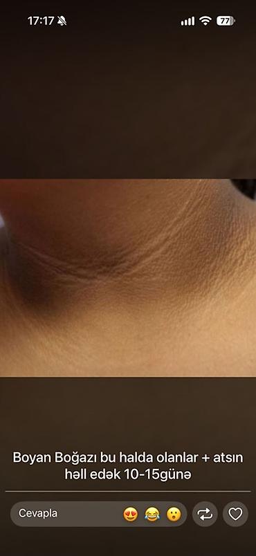 derın dondurucu: Qoltuqaltı, bikini və boyun nahiyəsindəki tündləşmənin azaldılması — 4