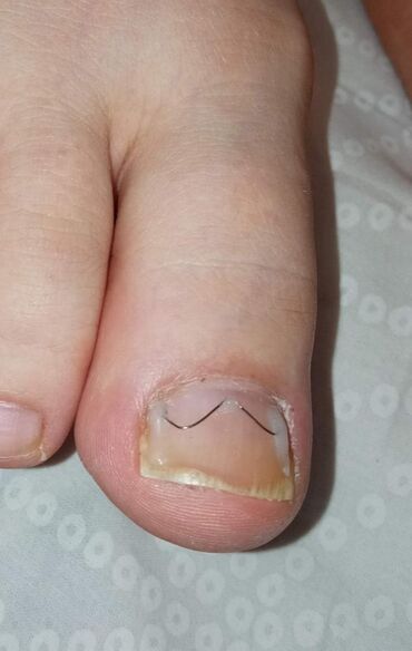 Маникюр, педикюр: Коррекция вросших ногтей, Маникюр, Педикюр, Услуги подолога, Консультация, Одноразовые расходные материалы — 21