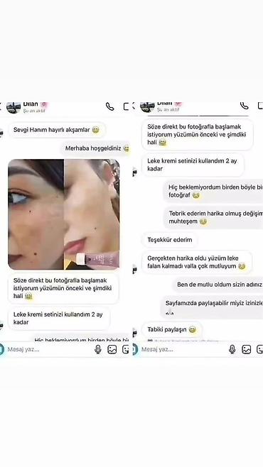 kosmetika qabı: Məhsul: Y-Peel Lightening Cream – ləkə qarşıtı və dəri tonu — 1