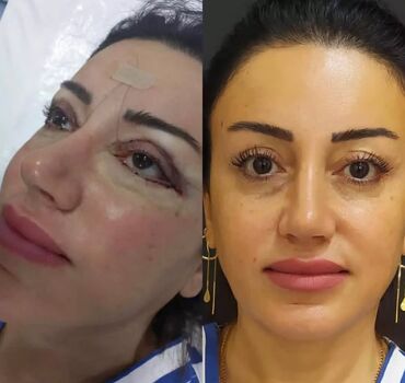 neftcilerde gozellik salonu: Blefaroplastika əməliyatı. Endirimlə 290azn analiz və həkimin müainəsi