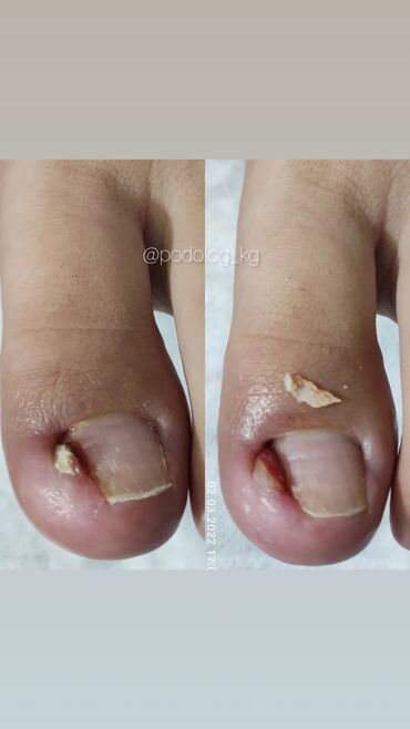 Маникюр, педикюр: Коррекция вросших ногтей, Маникюр, Педикюр, Услуги подолога, Консультация — 6