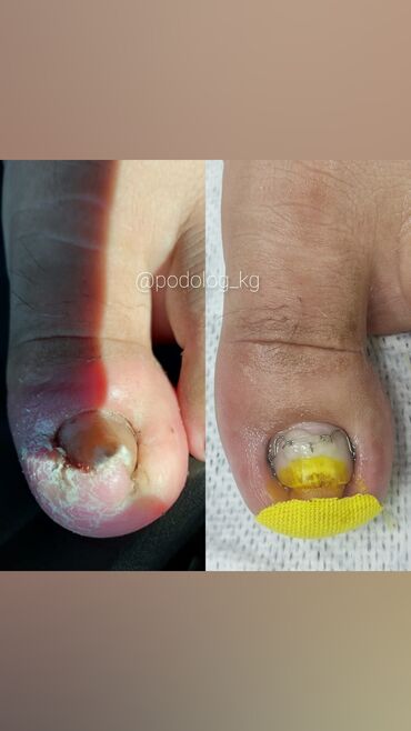 Маникюр, педикюр: Коррекция вросших ногтей, Маникюр, Педикюр, Услуги подолога, Консультация, Одноразовые расходные материалы — 12