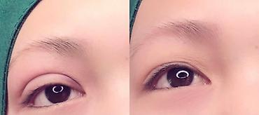 Косметология: Жип менен сурма чыгарабыз, операциясыз, кесилбейт, Оорубайт, шрам — 3