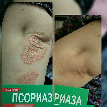 мазь cortam: Здравствуйте! Найден эффективный способ от Псориаза. Я сам болею этой — 2