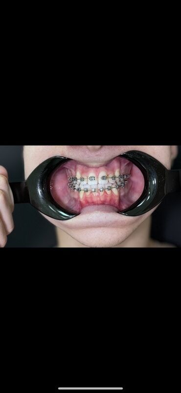 художественная реставрация зубов композитными материалами: Клиника | Стоматолог | Протезирование