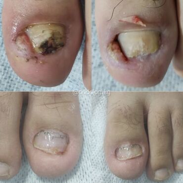 Маникюр, педикюр: Коррекция вросших ногтей, Педикюр, Услуги подолога, Консультация, Одноразовые расходные материалы — 10