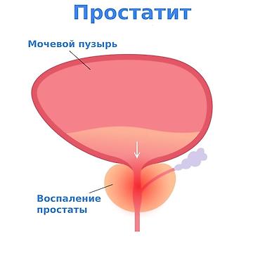 простатит: Врачи | Уролог | Консультация, Диагностика — 2