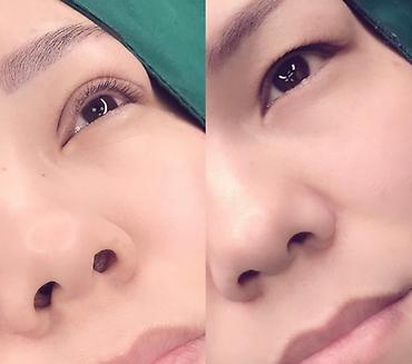 Косметология: Жип менен сурма чыгарабыз, операциясыз, кесилбейт, Оорубайт, шрам — 6