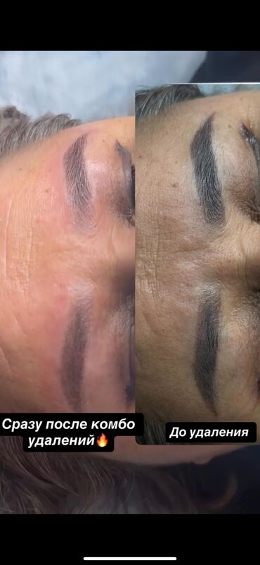 Перманентный макияж: АКЦИЯ !АКЦИЯ! Новый метод удаления Сейчас по акции Лазерное удаление — 17