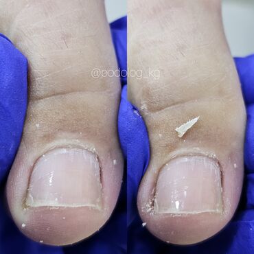 Маникюр, педикюр: Коррекция вросших ногтей, Маникюр, Педикюр, Услуги подолога, Консультация, Одноразовые расходные материалы — 15