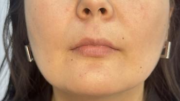 Косметология: Косметология, Увеличение губ, Гипоаллергенные материалы at lalafo.kg — 22 Косметология: Косметология, Увеличение губ, Гипоаллергенные материалы — 22