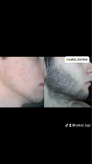 Уход за телом: Миноксидил ультра 15% 100мл 3 месяц хватает Для бороды и волосы — 6