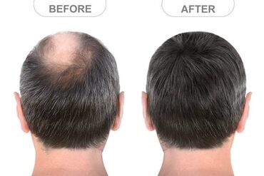 jaknica od eko: Minoxidil 5% sprej i kapi pobedite ćelavost obnovite rast kose