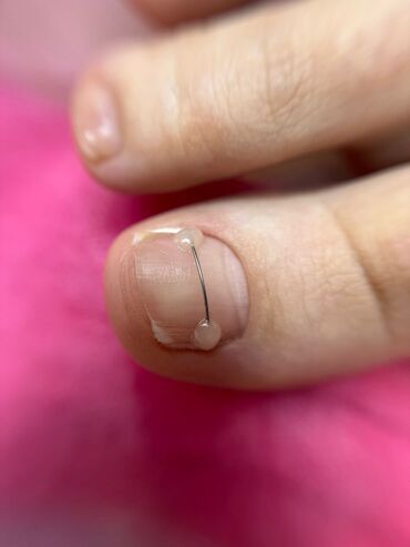 модели на ногти: Педикюр | Коррекция вросших ногтей | С выездом на дом, Консультация, Одноразовые расходные материалы