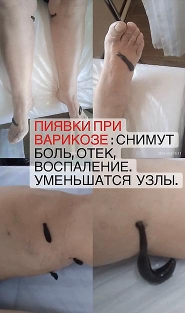 простатит: Врачи, Клиника | Гирудотерапевт | Диагностика, Консультация, Лечение пиявками — 4