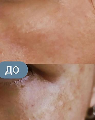 expigment реальные отзывы: Expigment Экспигмент Сроки до 2027 Свежая поставка с Турции 🇹🇷 💯% — 7
