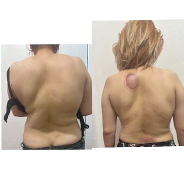 Masaj: Vakuum masajı, Qadınlar üçün — 4