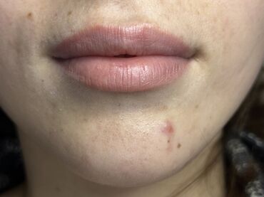 Косметология: Косметология, Маски, Мезотерапия, Удаление носогубных складок, Гипоаллергенные материалы, Консультация, Сертифицированный косметолог — 46