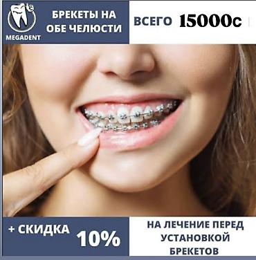 установка брекет: Услуга: установка брекет‑системы на обе челюсти. - Акция: стоимость — 2