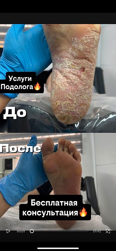 проф подология бишкек: Коррекция вросших ногтей, Услуги подолога, Консультация — 1