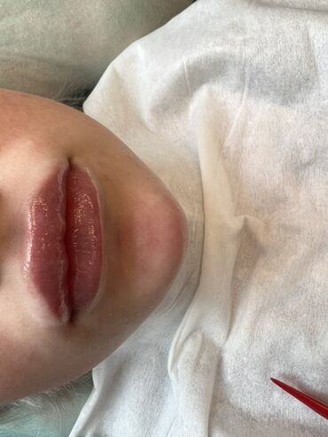 Косметология: Косметология, Ботокс, Биоревитализация, Ботулинотерапия, Консультация, Гипоаллергенные материалы, Сертифицированный косметолог — 25