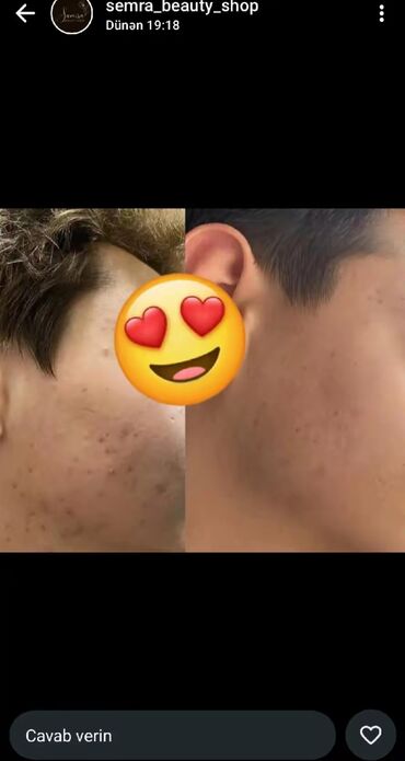 Saçlara qulluq: Saç üçün yağ, Saç tökülməsinə qarşı — 14