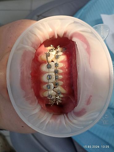 Ортезы: Ортодонтическое лечение: установка брекет‑системы на нижнюю челюсть - — 1