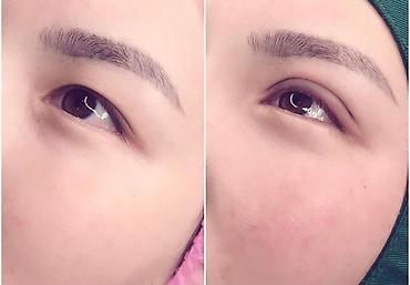 Косметология: Жип менен сурма чыгарабыз, операциясыз, кесилбейт, Оорубайт, шрам — 7