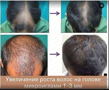 Уход за телом: Мезороллер разные размеры игл - прямые поставки - читаем текст смотрим — 4