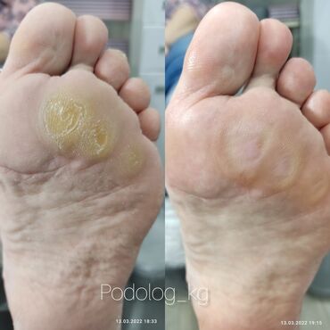 Маникюр, педикюр: Коррекция вросших ногтей, Маникюр, Педикюр, Услуги подолога, Консультация — 4