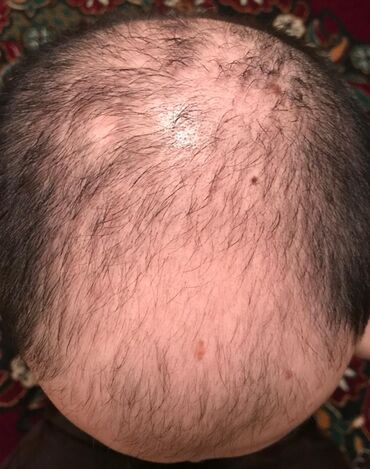 beard growth результаты в Кыргызстан: Миноксидил в городе Ош
Minoxidil kirkland оригинал 100%
Миноксидил 5%