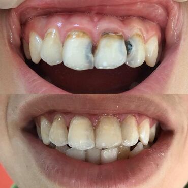 🦷Dişlerin estetik plomb ile berpasi