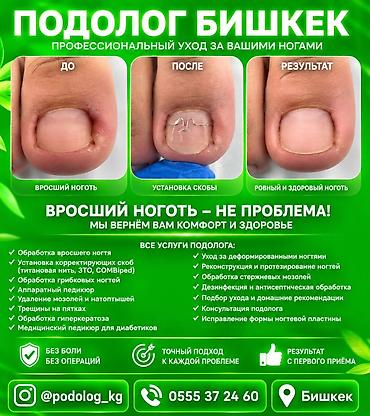 Ичине кирип өскөн тырмактарды оңдоо, Подолог кызматтары, Консультация
