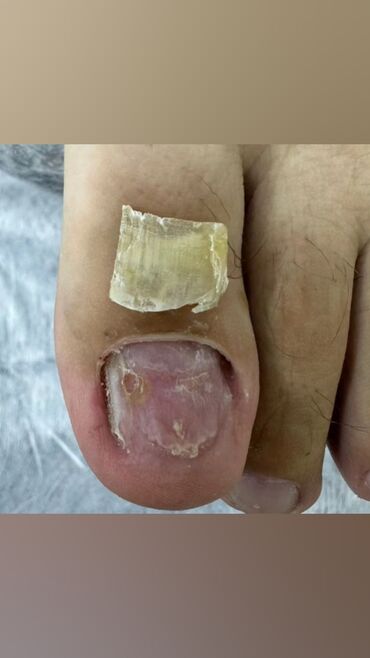 Маникюр, педикюр: Коррекция вросших ногтей, Маникюр, Педикюр, Услуги подолога, Консультация, Одноразовые расходные материалы — 9