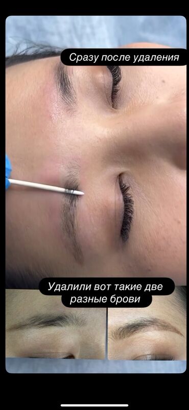 Перманентный макияж: АКЦИЯ !АКЦИЯ! Новый метод удаления Сейчас по акции Лазерное удаление — 1