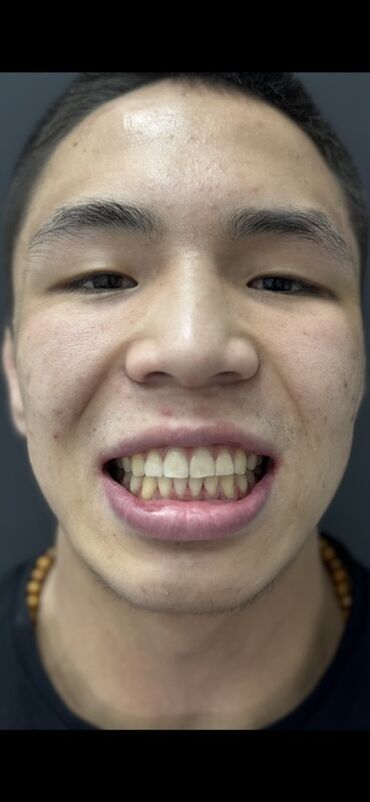 художественная реставрация зубов композитными материалами: Врачи | Стоматолог | Протезирование