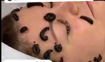 Hicama, zəli: Xidmət: Hicama, hirudoterapiya və masaj - Hicama terapiyası: Bədənin — 2