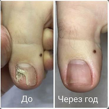 обувь 34: Услуги подолога (Жалал-Абад) Специализация: - Лечение вросшего ногтя — 7