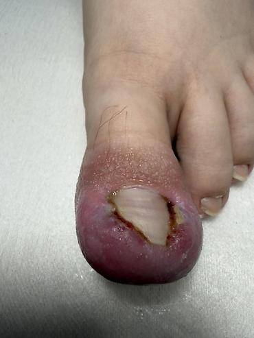 Маникюр: Коррекция вросших ногтей, Услуги подолога, Одноразовые расходные материалы — 7