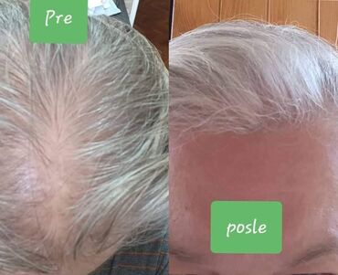 vazdusni jastuk za vrat: 📌📌📌Kosalim losion za novi rast kose sa klinički dokazanim dejstvom