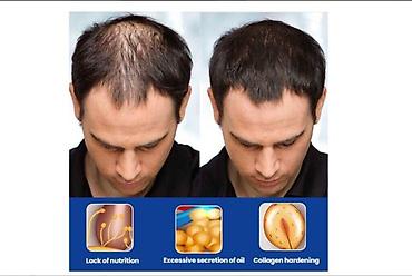 Уход за телом: США Миноксидил ОРИГИНАЛ от облысения ПЕНКА СПРЕЙ КОТОРУЮ НЕ — 4