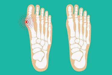 грелка для ног: Корректоры для большого пальца ноги от вальгусной деформации(косточки