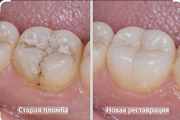 медцентр: Эстетическая реставрация жевательных зубов композитными материалами - — 1