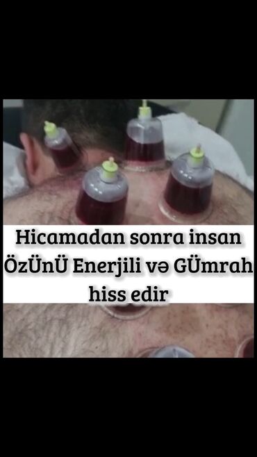 Hicama, zəli: Hicamanın Faydaları✅ *Qan dövranın pozulması *Qanın təmizlənməsi — 3