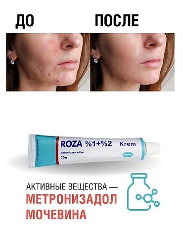 скинорен крем: Roza Роза для лечения розацеа,купероза и угревой сыпи. 💎Благодаря — 3